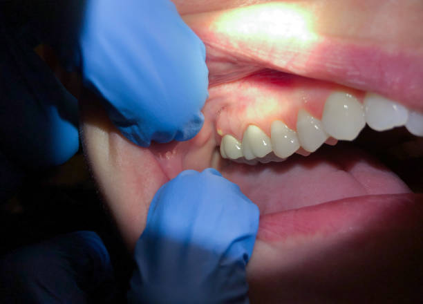 Best Lost Filling or Crown Replacement in Fort Riley, KS